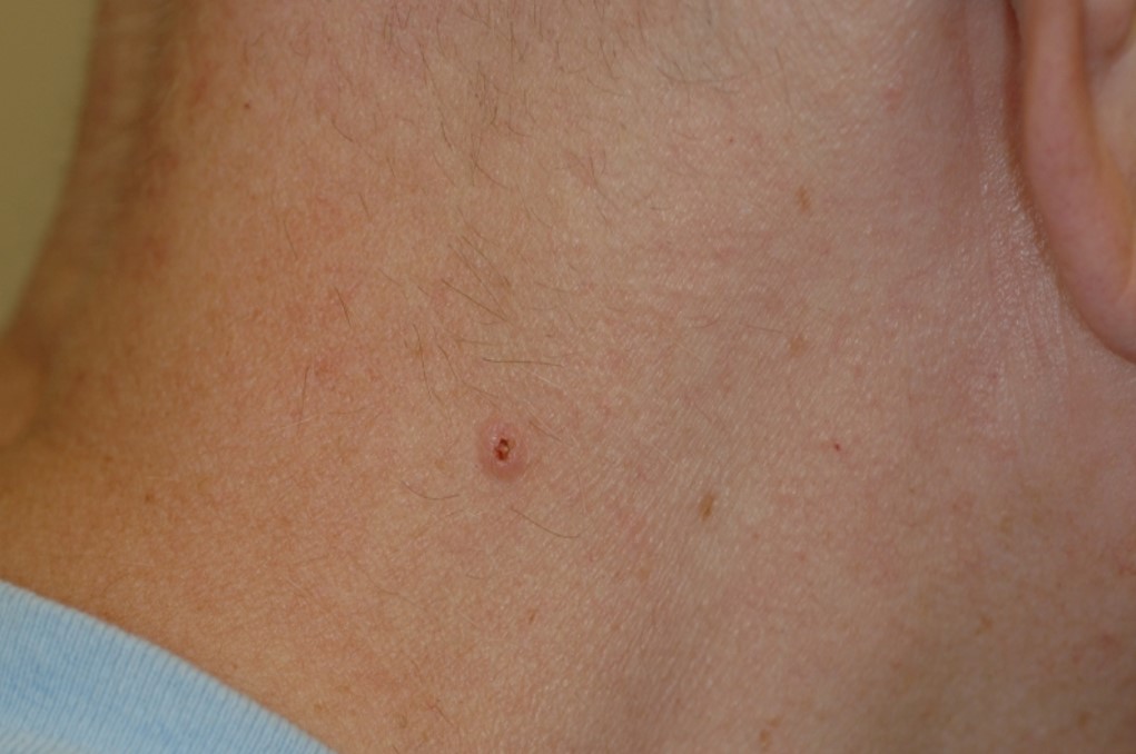 Disease Management Nonmelanoma Skin Cancer